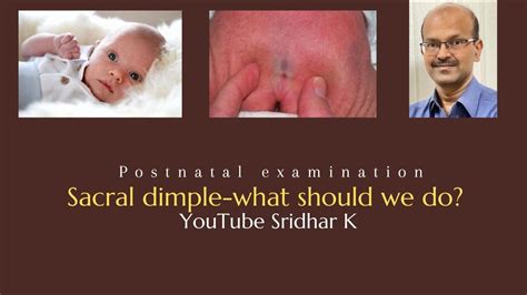 Please find the attached image and help me know is this some problem. . Baby sacral dimple when to worry